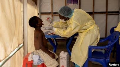 Santé : le Haut-Katanga notifie ses 2 premiers cas confirmés de Mpox